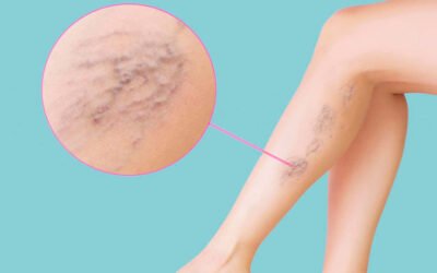 Apariția varicelor e specifică doar unei anumite vârste?