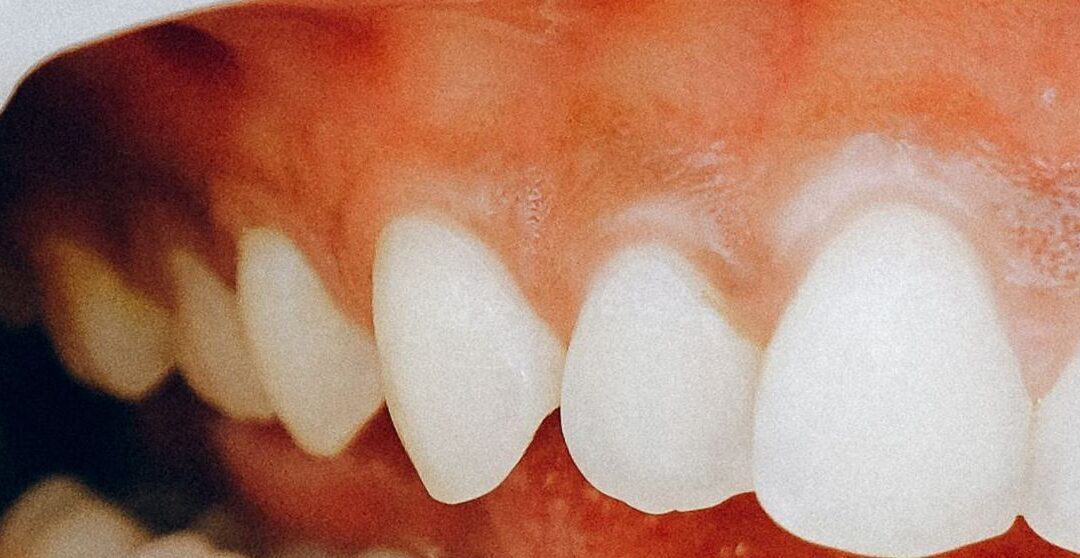 Retragerea gingiilor. Care sunt cauzele, cum să ameliorezi și motivul pentru care să nu ignori simptomele