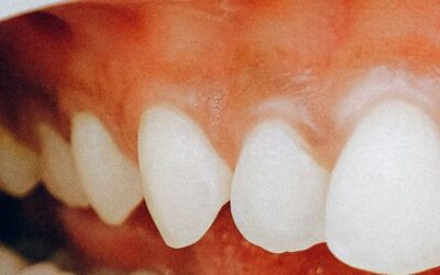 Când ar trebui să-mi fac griji cu privire la sângerarea gingiilor?